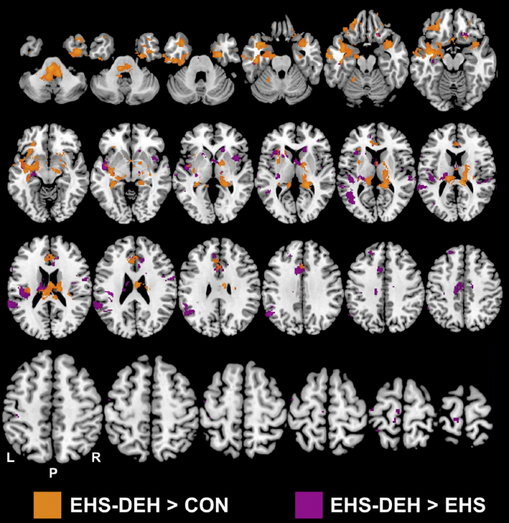 <p>fMRI of brain activity of dehydrated test persons. Orange represents the rise in activity over participants who experienced no exertion and no heat stress, but who hydrated. Purple is the rise in activity above test persons who experienced the same stressors as dehydrated test persons but who hydrated. Credit: Georgia Tech / CABI</p>