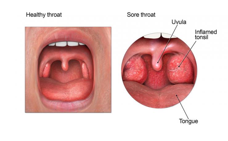 <p>Illustration of a sore throat, right. Credit: Centers for Disease Control and Prevention</p>