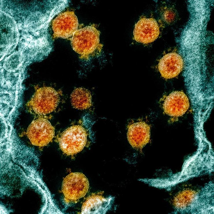 This colorized transmission electron micrograph shows SARS-CoV-2 virus particles (orange), isolated from a patient. Credit: NIAID via NIH