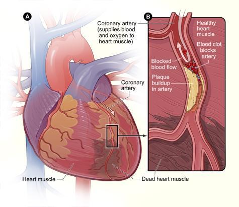 Coronary artery disease NIH