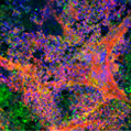 Image of GFP-expressing medulloblastoma organotypic tumor slice culture upon the treatment of eHNP-A1-CD15-LDE225. Image of GFP-expressing medulloblastoma organotypic tumor slice culture upon the treatment of eHNP-A1-CD15-LDE225. eHNP-A1-CD15-LDE225 exhibited localization in the perivascular niche ares of tumor tissues. Blue represents nucleus; green represents SmoA1 medulloblastoma cells; red represents eHNP-A1-CD15-LDE225. 