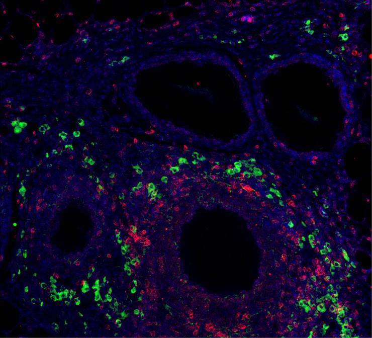 <p>Immunomodulatory signal presentation via synthetic hydrogel material promotes generation of T regulatory cells (green) in the local graft microenvironment (CD3+ T cells in red, and nuclei staining in blue) after implantation into a clinically relevant transplant model for the treatment of type 1 diabetes. (Credit: Georgia Tech)</p>