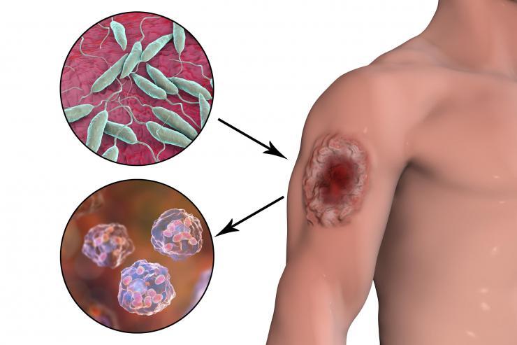 Leishmaniasis infector-disease illustration