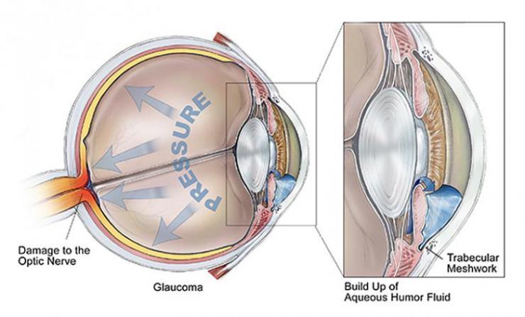 Glaucoma depiction BrightFocus Foundation